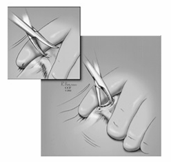 정관수술 과정 일러스트 1