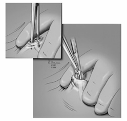 정관수술 과정 일러스트 2